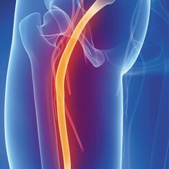 Illustration of the sciatic nerve running from the hip down the leg